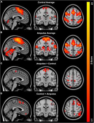 Cortical activation during imagined walking for people with lower limb loss: a pilot study